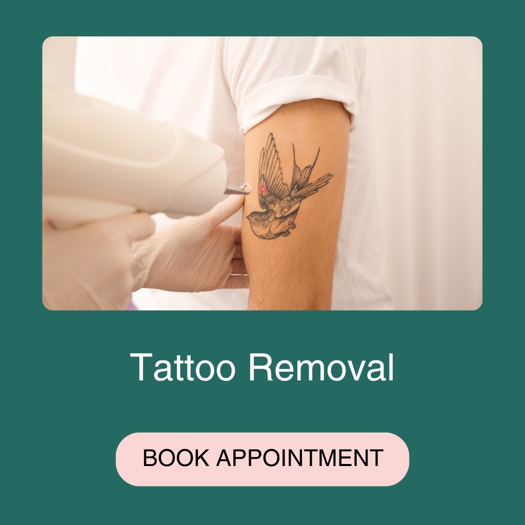 Tatto Removal