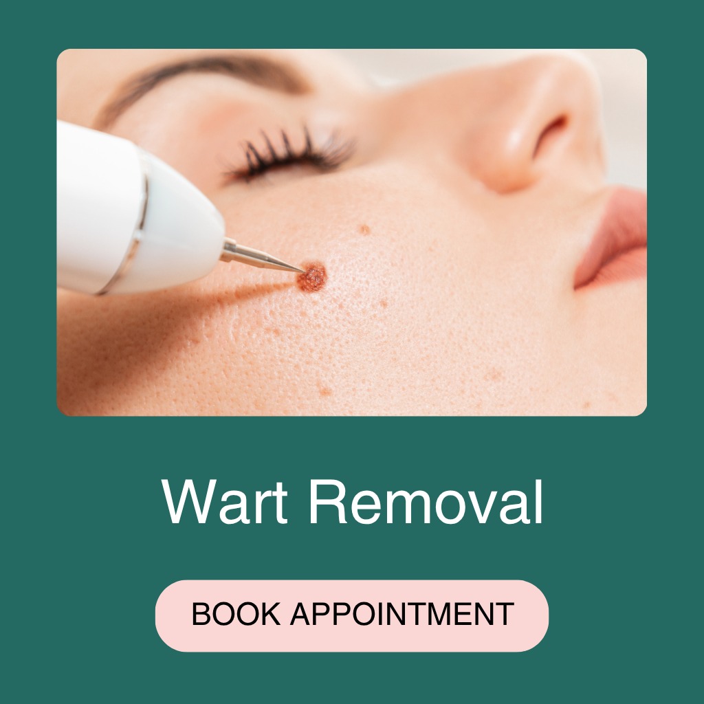 Wart Removal